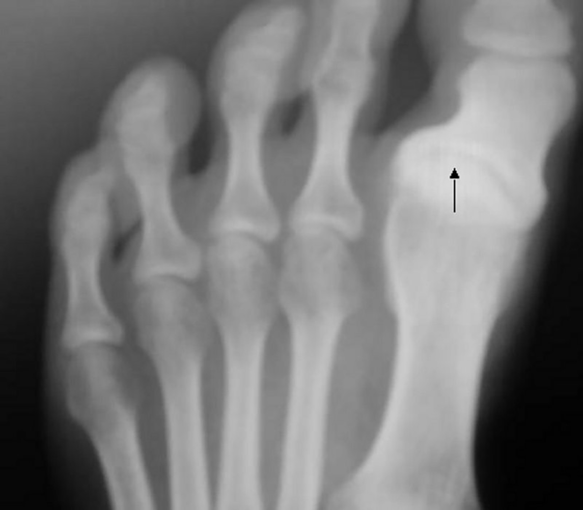 S-King-Information About Hallux Varus And How To Correct It | Foot Health